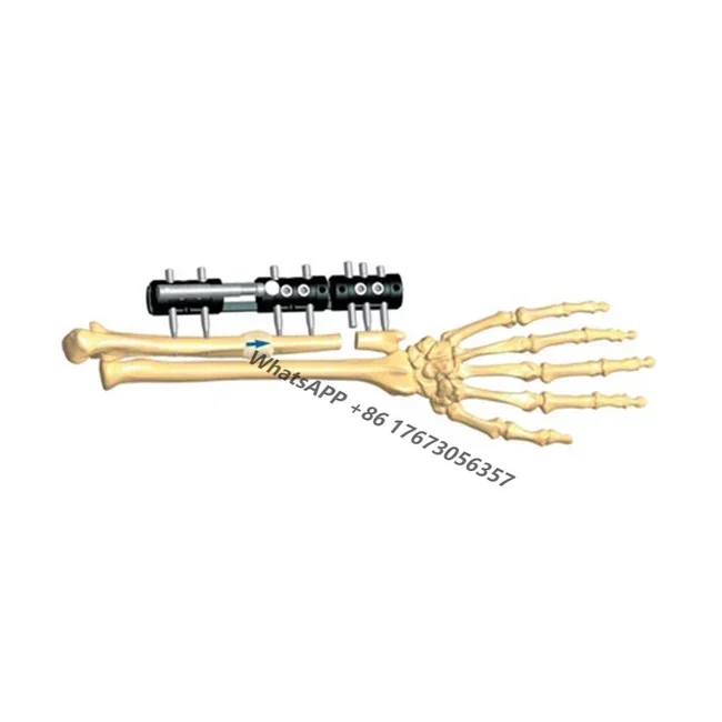 Фиксатор травмы При потере костной массы в локтевой кости, лечится транспортировкой кости с помощью фиксатора